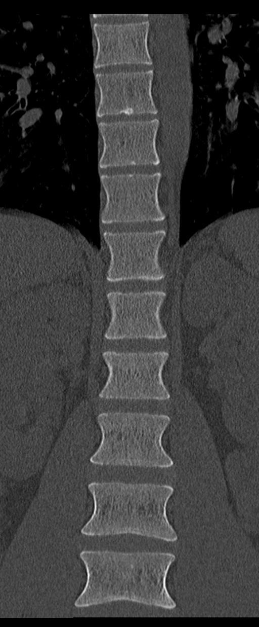 Aneurysmal bone cyst T11 (Radiopaedia 29294-29721 Coronal bone window 21).jpg