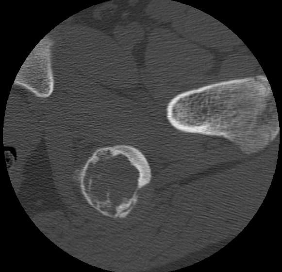 Aneurysmal bone cyst of ischium (Radiopaedia 25957-26094 B 30).png