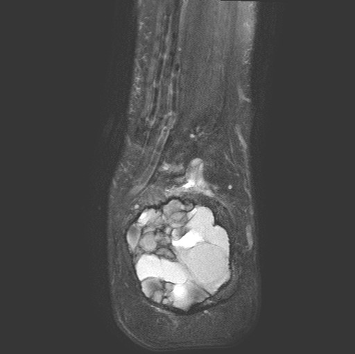 File:Aneurysmal bone cyst of the calcaneus (Radiopaedia 60669-68420 Coronal T2 fat sat 19).jpg