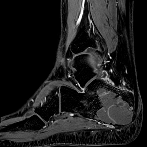 File:Aneurysmal bone cyst of the calcaneus (Radiopaedia 60669-68420 F 11).jpg