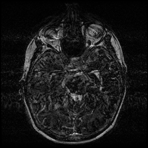 Angioinvasive aspergillosis in the pituitary fossa (Radiopaedia 39676-42010 Ax 3D FIESTA VOLUME 59).png