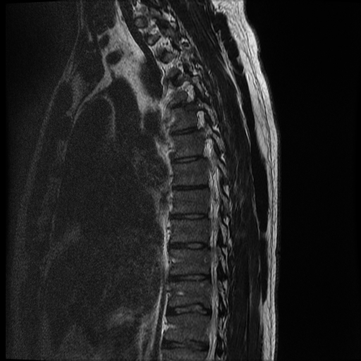 File:Angiolipoma - thoracic spine (Radiopaedia 28242-28479 Sagittal T2 10).jpg