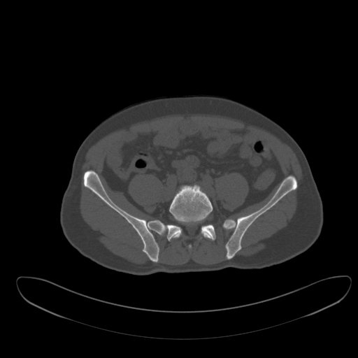 Ankylosing spondylitis (Radiopaedia 52728-58645 Axial bone window 2).jpg