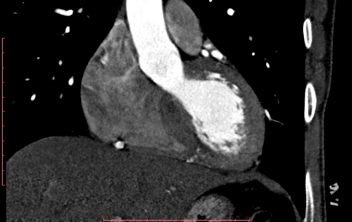Anomalous left coronary artery from the pulmonary artery (ALCAPA) (Radiopaedia 70148-80181 B 120).jpg