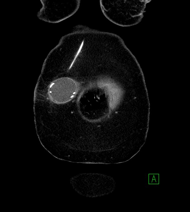 Anterior abdominal wall CSF pseudocyst (CSFoma) (Radiopaedia 79453-92571 B 10).jpg