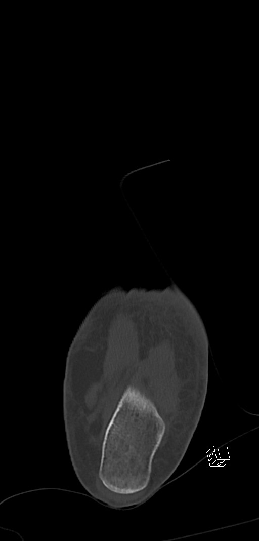 Anterior calcaneal process fracture (Radiopaedia 63353-71943 Coronal bone window 43).jpg