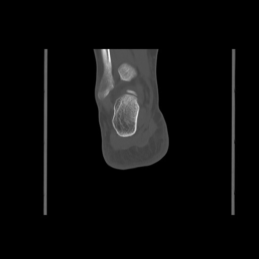 File:Anterior calcaneal process fracture (Radiopaedia 82590-96762 Coronal bone window 62).jpg