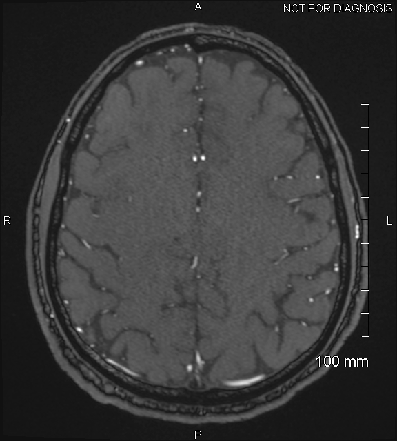 Anterior cerebral artery aneurysm (Radiopaedia 80683-94127 Axial MRA 186).jpg