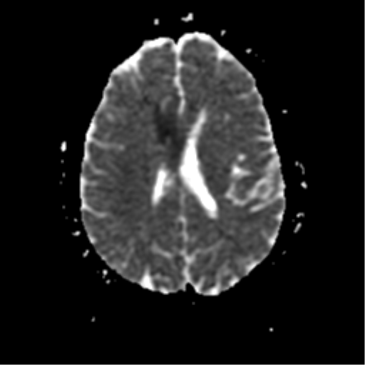 File:Anterior cerebral artery territory infarct (Radiopaedia 39327-41584 Axial ADC 16).png