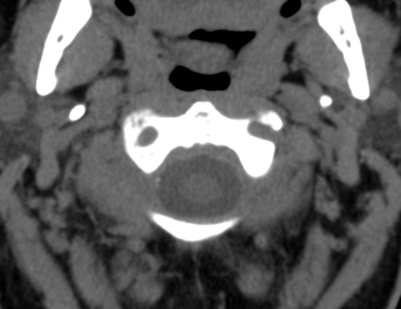 Anterior cervical postdiscectomy arthrodesis (Radiopaedia 32678-33646 Axial non-contrast 18).jpg