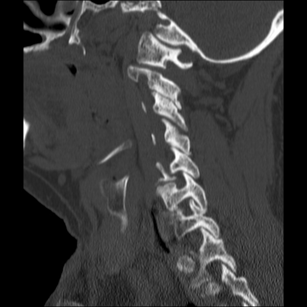 Anterior cervical postdiscectomy arthrodesis (Radiopaedia 32678-33646 Sagittal bone window 54).jpg