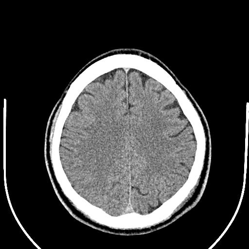 Anterior choroidal artery infarct (Radiopaedia 55106-61480 Axial non-contrast 43).jpg