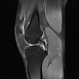 File:Anterior cruciate ligament full thickness tear (Radiopaedia 66268-75467 Sagittal PD fat sat 11).jpg