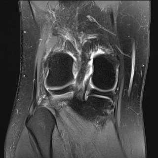 File:Anterior cruciate ligament rupture and posteromedial corner injury (Radiopaedia 67338-76723 Coronal PD fat sat 7).jpg
