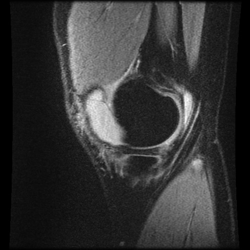 Anterior cruciate ligament tear (Radiopaedia 61500-69462 F 7).jpg