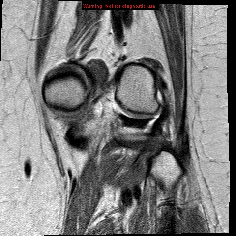 File:Anterior cruciate ligament tear - complete (Radiopaedia 12175-12514 C 19).jpg