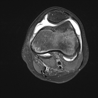 File:Anterior cruciate ligament tear - pediatric (Radiopaedia 62152-70260 Axial PD fat sat 13).jpg