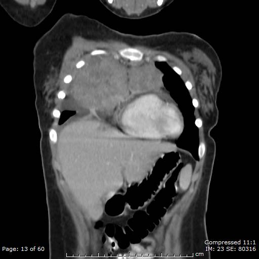 File:Anterior mediastinal B cell Lymphoma (Radiopaedia 50677-56114 B 7).jpg