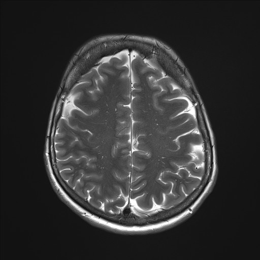 File:Anterior temporal encephalocele (Radiopaedia 82624-96808 Axial T2 29).jpg