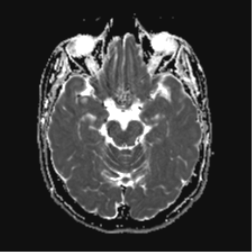 File:Anterior temporal lobe perivascular space (Radiopaedia 40946-43650 Axial ADC 10).png