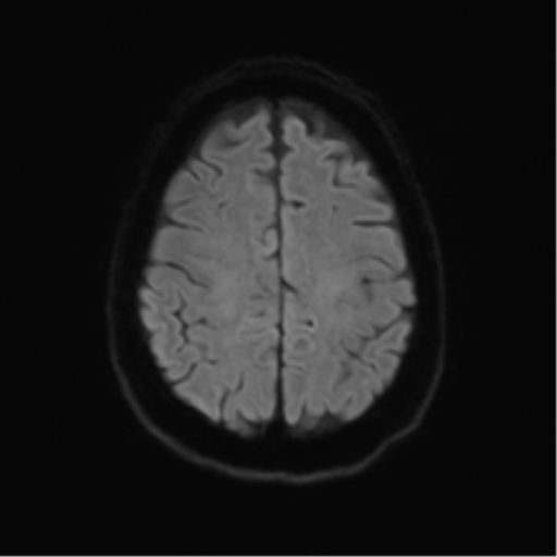 File:Anterior temporal pole cysts (Radiopaedia 46629-51102 Axial DWI 48).png