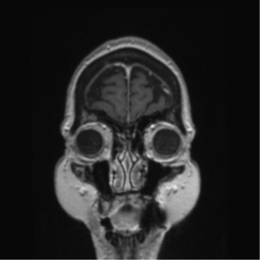 Anterior temporal pole cysts (Radiopaedia 46629-51102 Coronal T1 C+ 157).png