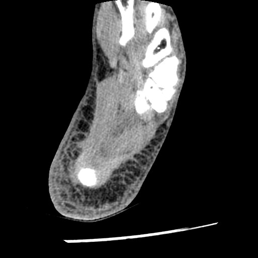 File:Anterior tibial artery false aneurysm (Radiopaedia 88984-105809 A 222).jpg