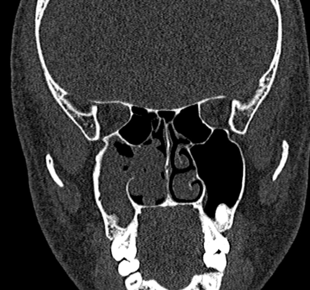 Antrochoanal polyp (Radiopaedia 30002-30554 Coronal bone window 45).jpg