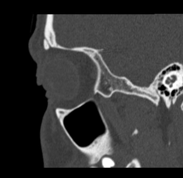 Antrochoanal polyp (Radiopaedia 33984-35202 Sagittal bone window 70).jpg