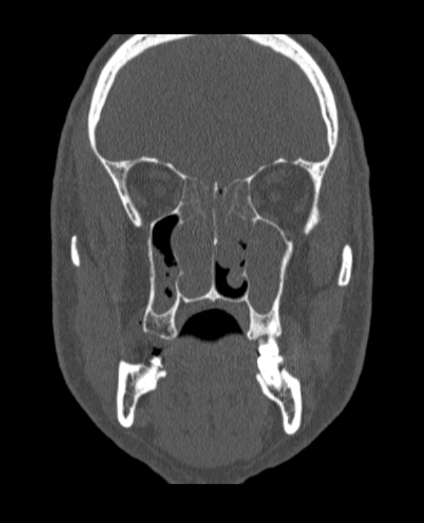 Antrochoanal polyp (Radiopaedia 79011-92169 Coronal bone window 42).jpg