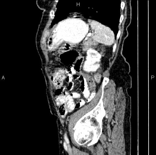 Aortic aneurysm and Lemmel syndrome (Radiopaedia 86499-102554 D 72).jpg