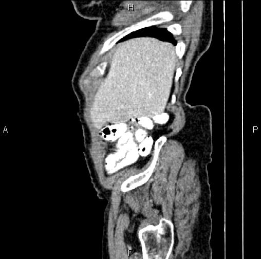 Aortic aneurysm and Lemmel syndrome (Radiopaedia 86499-102554 D 8).jpg