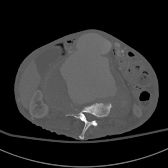 Aortic aneurysm with spinal destruction (Radiopaedia 42301-45410 Axial bone window 45).jpg