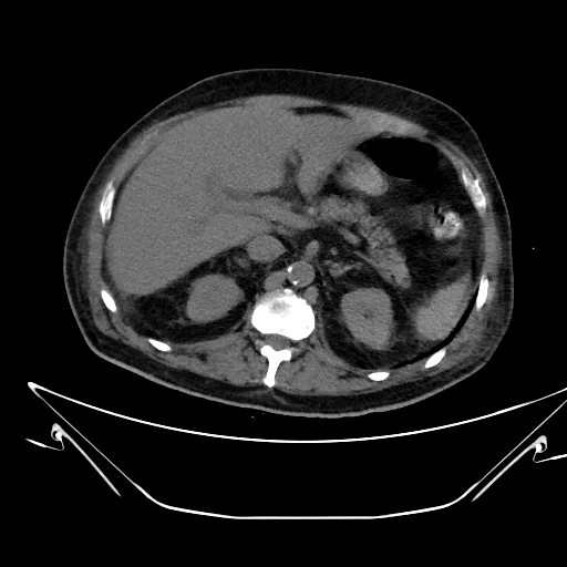 Aortic arch aneurysm (Radiopaedia 84109-99365 Axial non-contrast 294).jpg