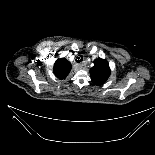 Aortic arch aneurysm (Radiopaedia 84109-99365 B 101).jpg