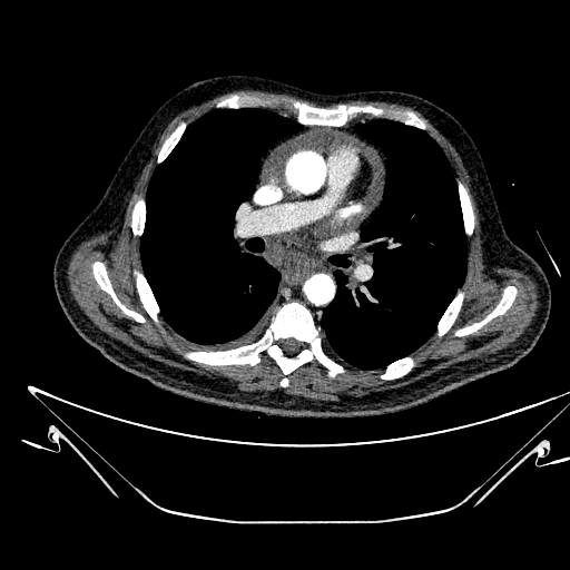 Aortic arch aneurysm (Radiopaedia 84109-99365 B 304).jpg