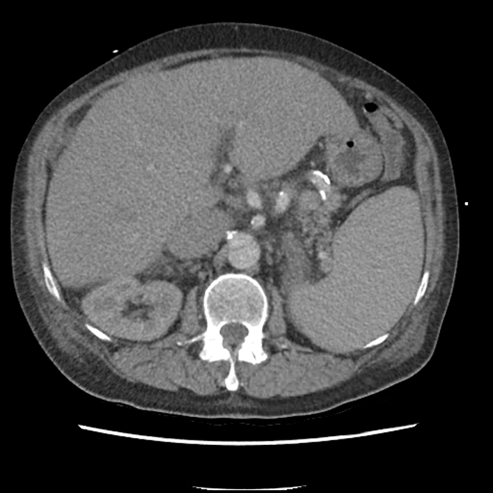Aortic arch graft infection (FDG PET-CT) (Radiopaedia 71975-82437 A 69).jpg