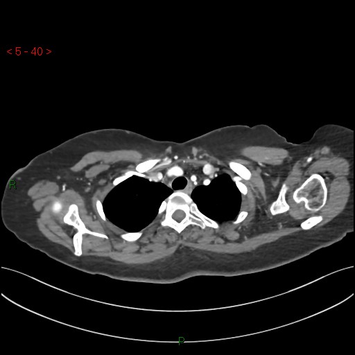 Aortic arch origin of left vertebral artery (Radiopaedia 51520-57286 A 39).jpg