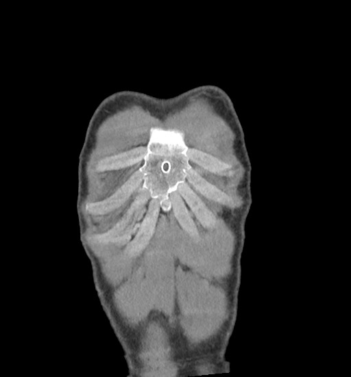 Aortic coarctation with aneurysm (Radiopaedia 74818-85828 C 9).jpg