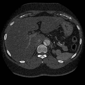 Aortic dissection (Radiopaedia 57969-64959 A 313).jpg