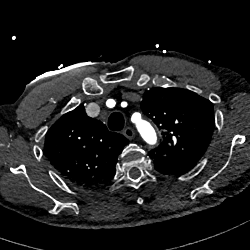 Aortic dissection - DeBakey type II (Radiopaedia 64302-73082 A 20).png