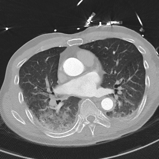 Aortic dissection - DeBakey type II (Radiopaedia 64302-73082 Axial lung window 33).png