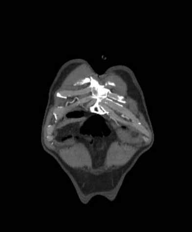 Aortic dissection - Stanford type B (Radiopaedia 73648-84437 B 5).jpg