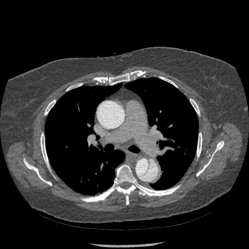 Aortic dissection - Stanford type B (Radiopaedia 88281-104910 A 33).jpg