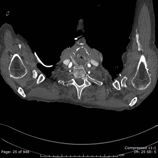 File:Aortic dissection with extension into aortic arch branches (Radiopaedia 64402-73204 B 25).jpg