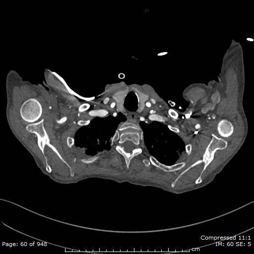 File:Aortic dissection with extension into aortic arch branches (Radiopaedia 64402-73204 B 60).jpg