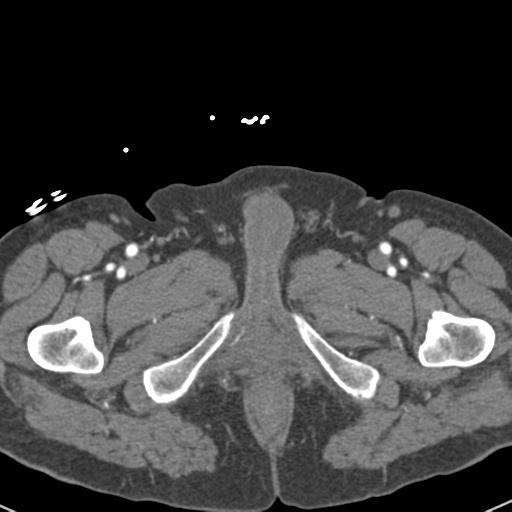Aortic intramural hematoma (Radiopaedia 31139-31838 B 181).jpg