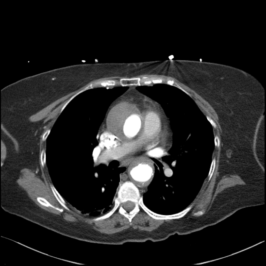 Aortic intramural hematoma with dissection and intramural blood pool (Radiopaedia 77373-89491 B 58).jpg