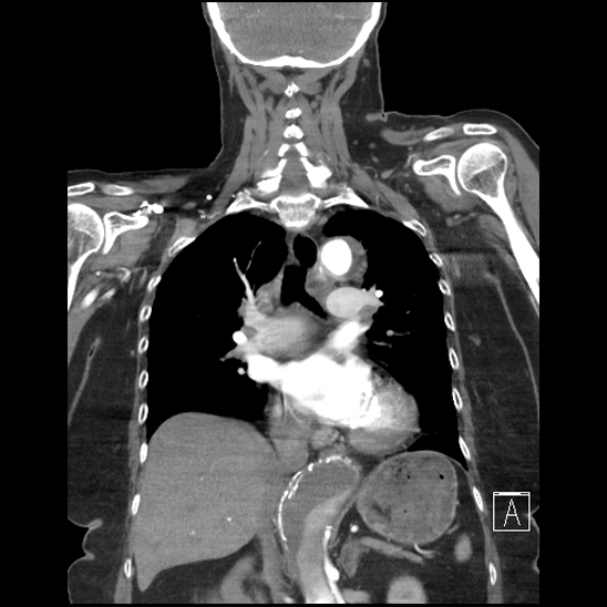 Aortic intramural hematoma with dissection and intramural blood pool (Radiopaedia 77373-89491 C 33).jpg
