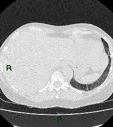 File:Aortic valve endocarditis (Radiopaedia 87209-103485 Axial lung window 86).jpg